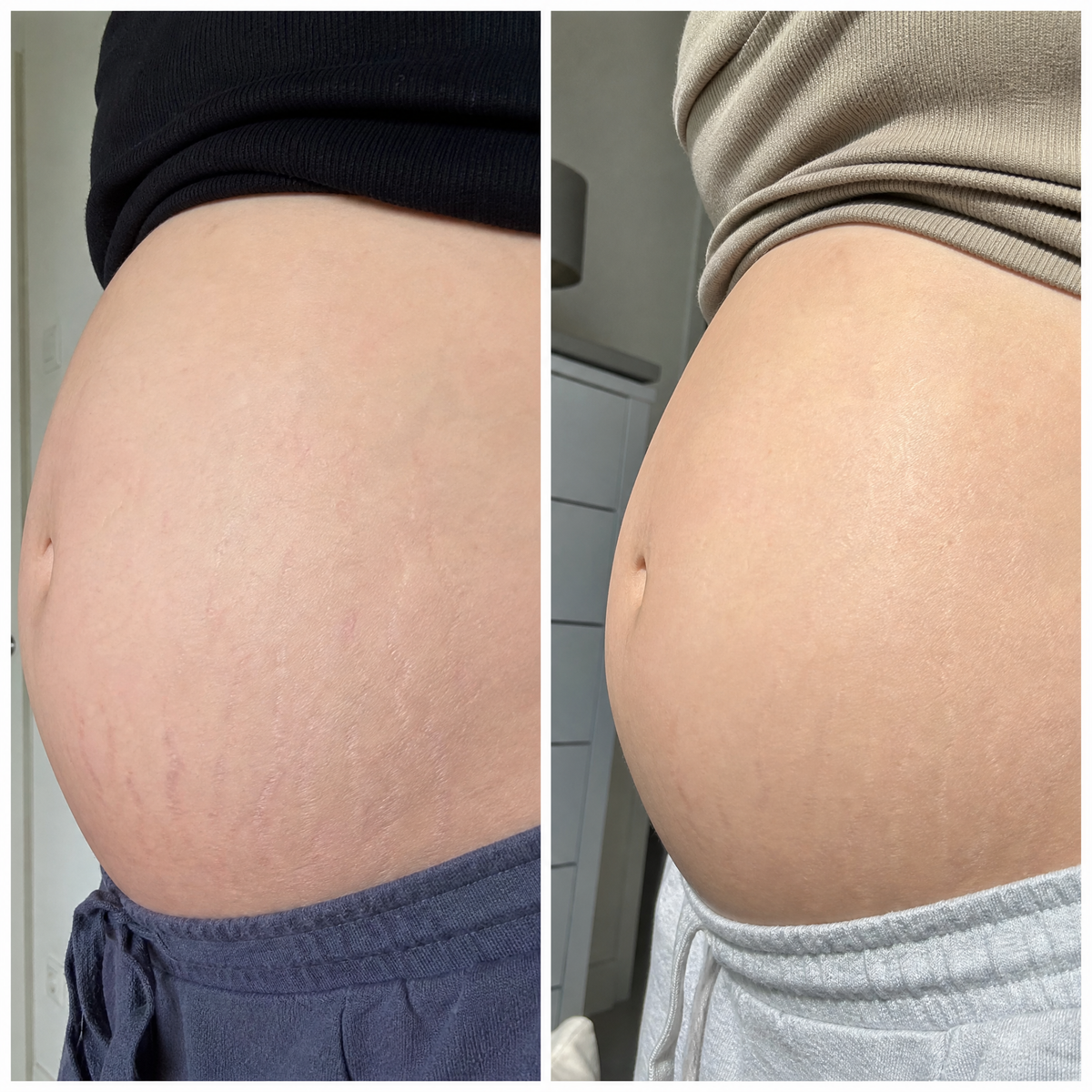 BEAUTY MAMA 100 - Масло против стрии за бременни