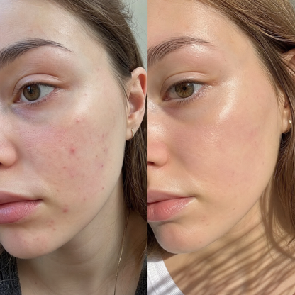 Мехлем при акне - ACNE GONE