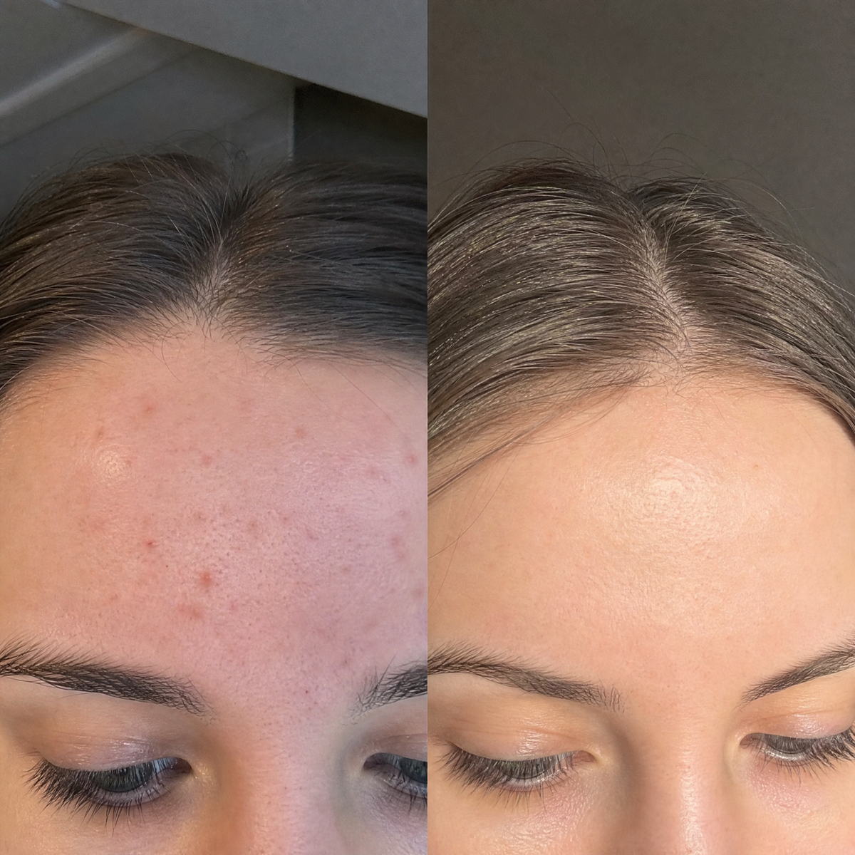 ПРОМО Комплект при акне ACNE GONE