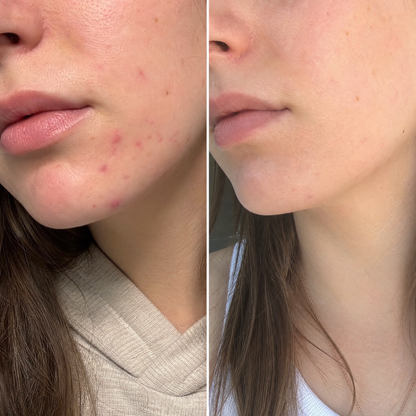 Мехлем при акне - ACNE GONE