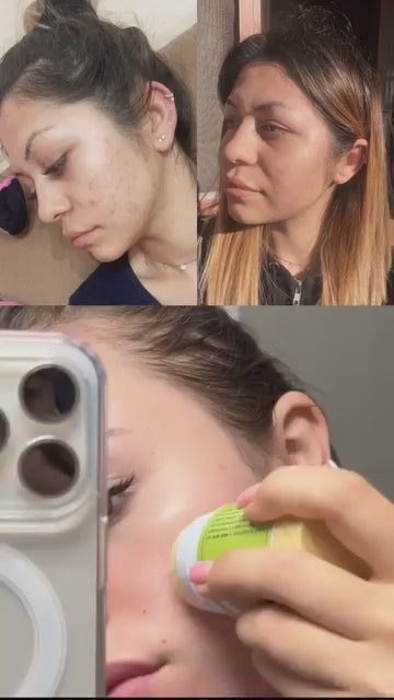 Мехлем при акне - ACNE GONE - клиентска снимка