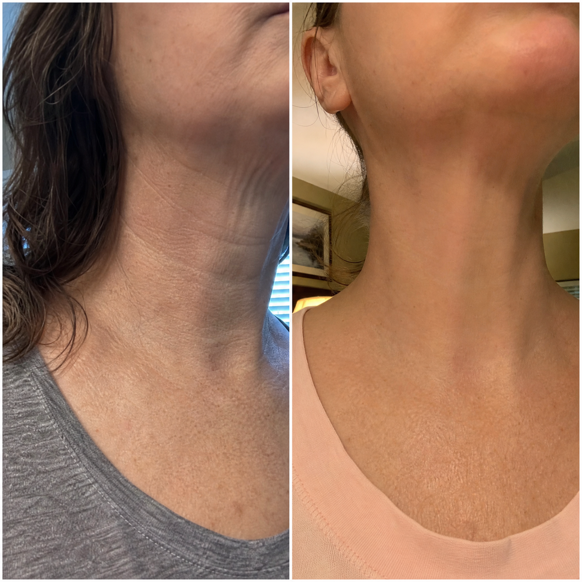 Серум за шия и деколте SCULPT - three drops before after