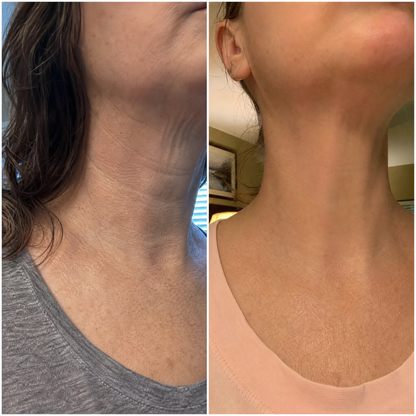 Серум за шия и деколте SCULPT - three drops before after